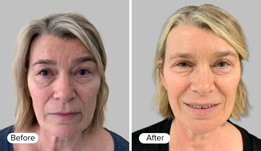 A split image showing two portraits of a woman. The left side is labeled 'Before' and features a woman with visible signs of aging and a neutral expression. The right side is labeled 'After' and displays the same woman with a rejuvenated appearance,