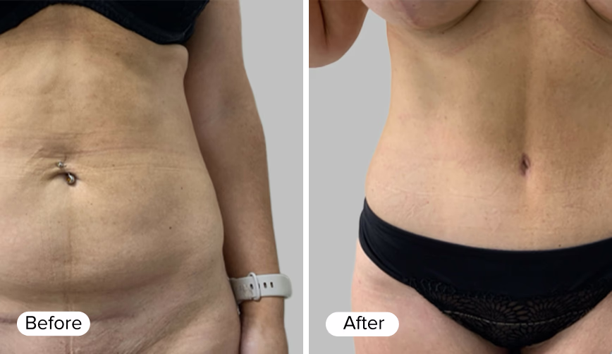 A side-by-side comparison of two images showing a woman's abdomen. The left image is labeled 'Before' and depicts loose skin and stretch marks, while the right image is labeled 'After' and shows a smoother abdomen with reduced visibility of stretch marks.