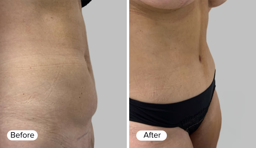 A side-by-side comparison of a person's abdomen showing 'Before' on the left and 'After' on the right. The 'Before' image displays visible skin texture and folds, while the 'After' image shows smoother skin.