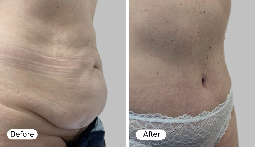 A side-by-side comparison image showing two torso views labeled 'Before' on the left and 'After' on the right. The 'Before' image displays loose skin with visible stretch marks, while the 'After' image shows a tighter appearance of the skin with a flatter