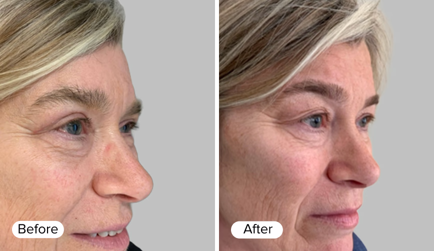 A side profile comparison of a woman's face divided into two sections labeled 'Before' and 'After'. The 'Before' section shows visible wrinkles and lines, while the 'After' section features smoother skin with reduced signs of aging.