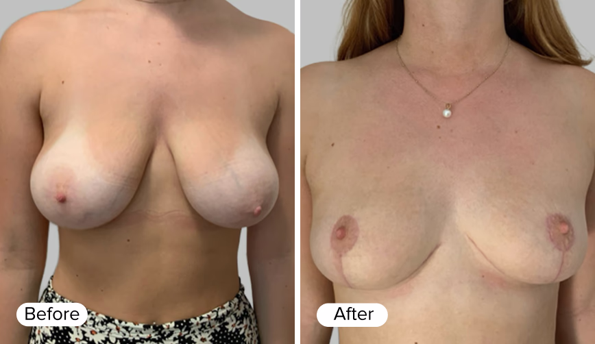 A side-by-side comparison of two images labeled 'Before' and 'After', showing the transformation in appearance of a woman’s chest.