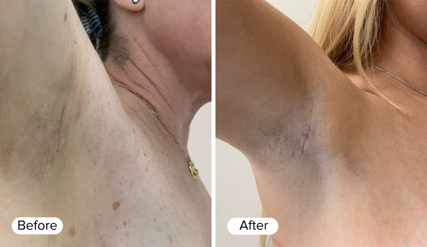 A side-by-side comparison of two underarms, labeled 'Before' on the left and 'After' on the right. The left side shows skin with visible hair follicles and slight discoloration, while the right side depicts smoother skin with minimal discoloration and a