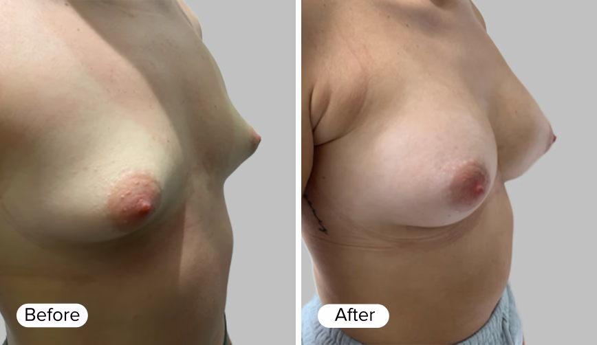 A side-by-side comparison image showing two female torsos with marked differences in breast appearance. The left side is labeled 'Before' and displays a breast shape with less fullness, while the right side is labeled 'After' and shows a fuller breast