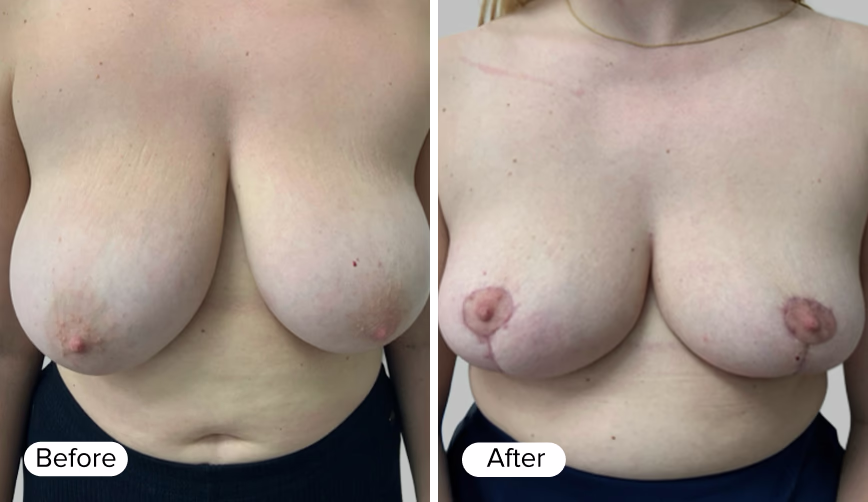 A side-by-side comparison of a woman’s chest before and after a cosmetic procedure, showing differences in contour and appearance.
