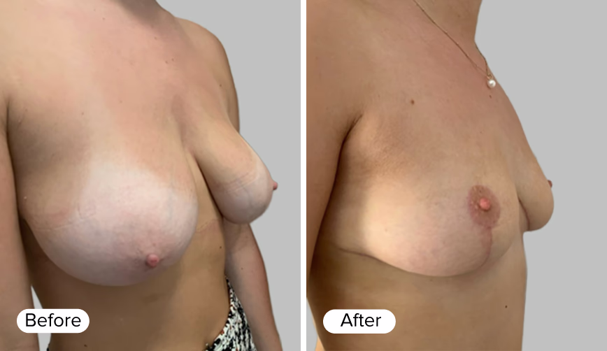 A side-by-side comparison showing two images of a woman's upper body. The left image shows the 'Before' view, with noticeable differences in breast shape. The right image shows the 'After' view, displaying a different breast contour.