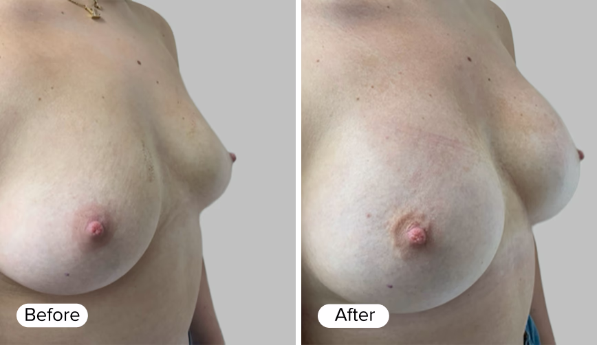 Before and after images showing the side profile of a woman's chest, with the text 'Before' in a white rounded rectangle below the left image and 'After' in a white rounded rectangle below the right image.
