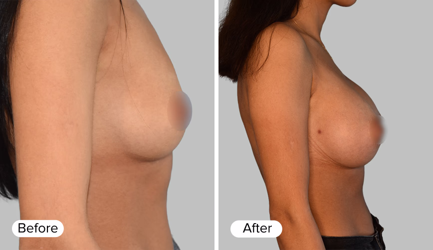 A side-by-side comparison image labeled 'Before' on the left and 'After' on the right, showing the profile views of a woman's torso before and after a breast enhancement procedure.