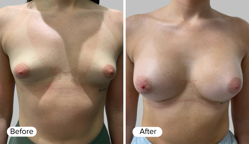 A side-by-side comparison image showing two female figures. The left side displays the 'Before' image, revealing a breast appearance with less volume. The right side shows the 'After' image, indicating fuller breasts with enhanced shape and contour.