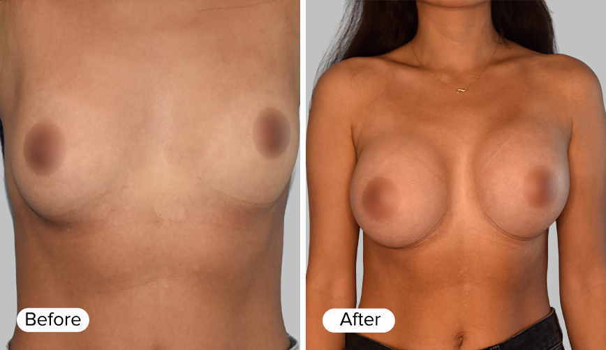 A side-by-side comparison image showing two female torsos labeled 'Before' on the left and 'After' on the right, with variations in breast appearance.