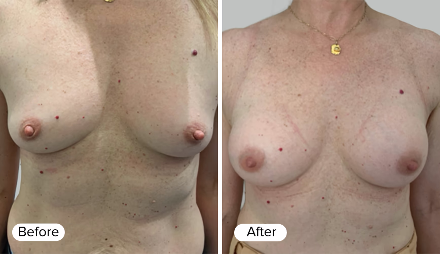 A side-by-side image showing two women's chests labeled 'Before' and 'After.' The 'Before' image shows a chest with uneven breast shapes and visible skin imperfections. The 'After' image displays a more symmetrical breast shape with smoother skin.