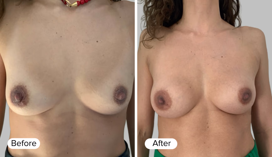 A side-by-side comparison image labeled 'Before' on the left and 'After' on the right, showcasing two different states of a person's upper body.
