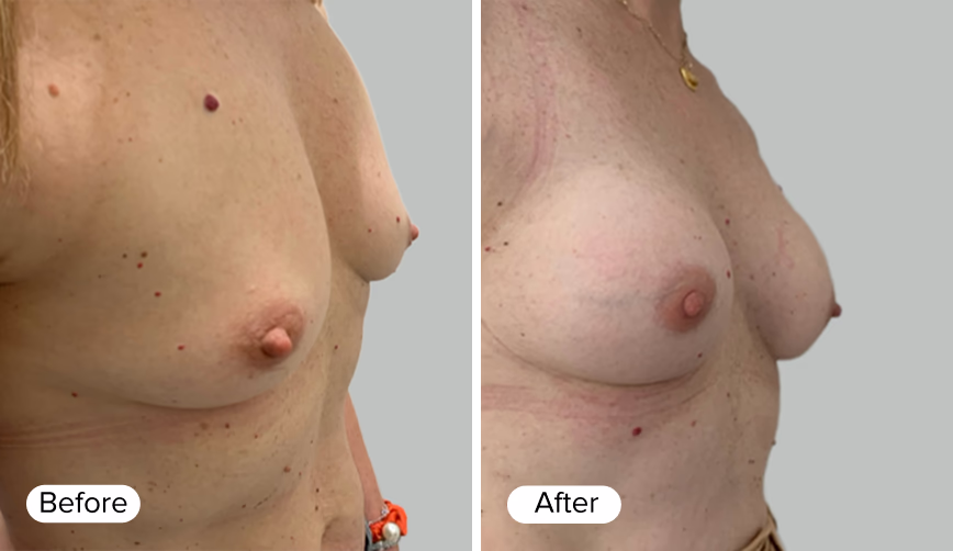 A side-by-side comparison image showing two female torsos labeled 'Before' on the left and 'After' on the right, illustrating a cosmetic procedure with differences in breast shape and appearance.