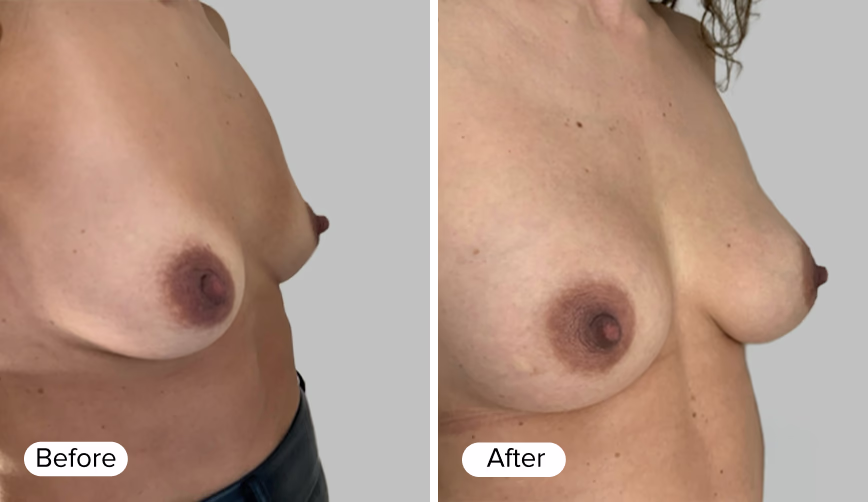 A side-by-side comparison image labeled 'Before' on the left and 'After' on the right, depicting breast enhancements. Both images show the profile of a woman's torso before and after a breast enhancement procedure.