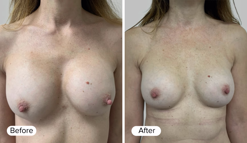 A side-by-side comparison of two images of a woman’s upper torso. The left image is labeled 'Before' and shows a fuller appearance, while the right image is labeled 'After' and displays a slimmer physique with more visible skin texture and slight scarring.