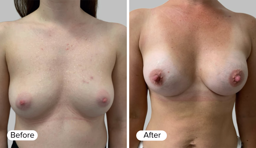 A 'Before' label on the left side and an 'After' label on the right side, each adjacent to images of a woman's upper body showing the differences in skin appearance and texture.