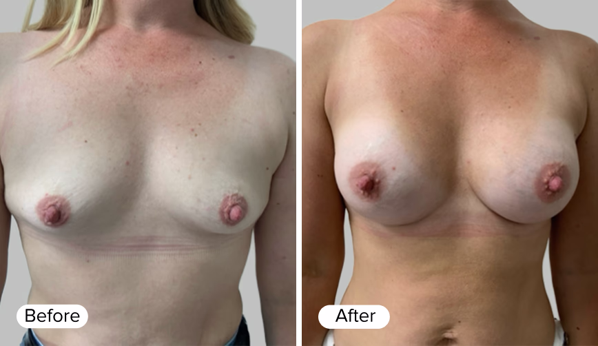 A side-by-side comparison showing two images labeled 'Before' on the left and 'After' on the right, depicting the results of a cosmetic procedure. The image on the left features a person with lighter skin tone and visible markings, while the image on the