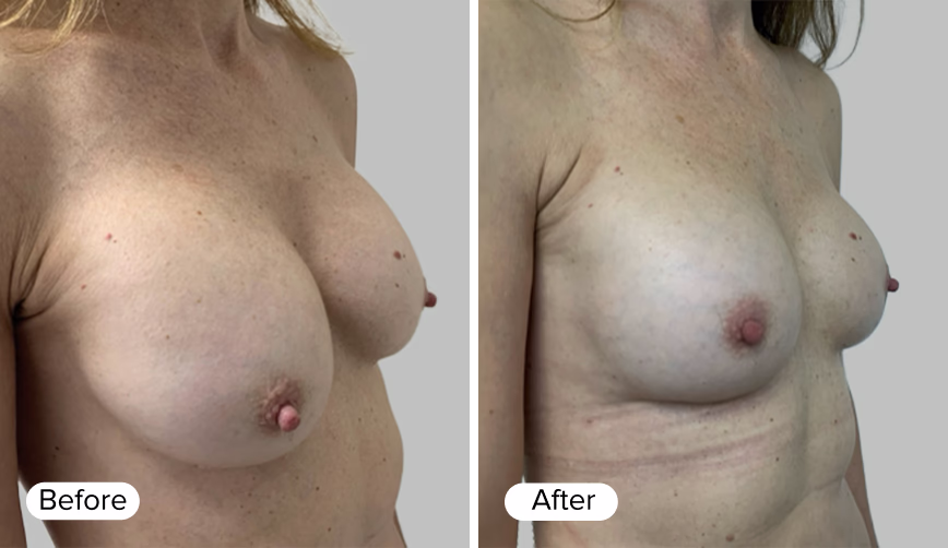 A side-by-side comparison of a woman's torso, labeled 'Before' on the left and 'After' on the right, showcasing changes in breast appearance.