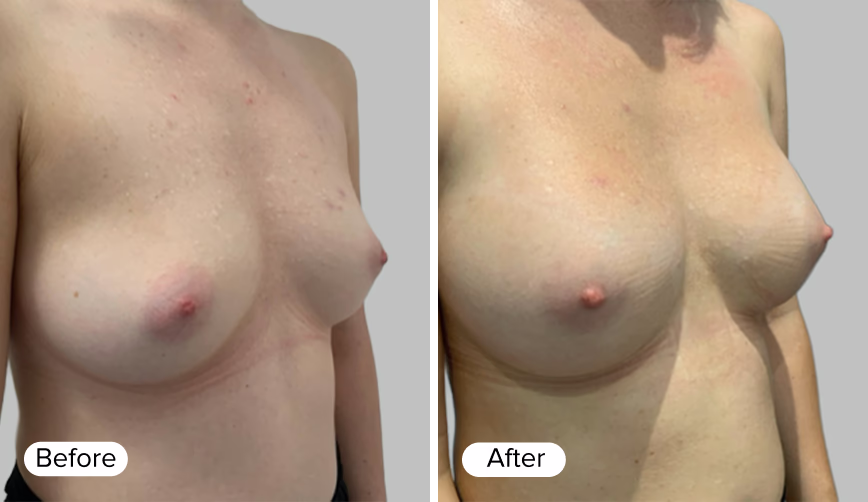 A side-by-side comparison of two images labeled 'Before' and 'After', showing changes in the appearance of the breasts.