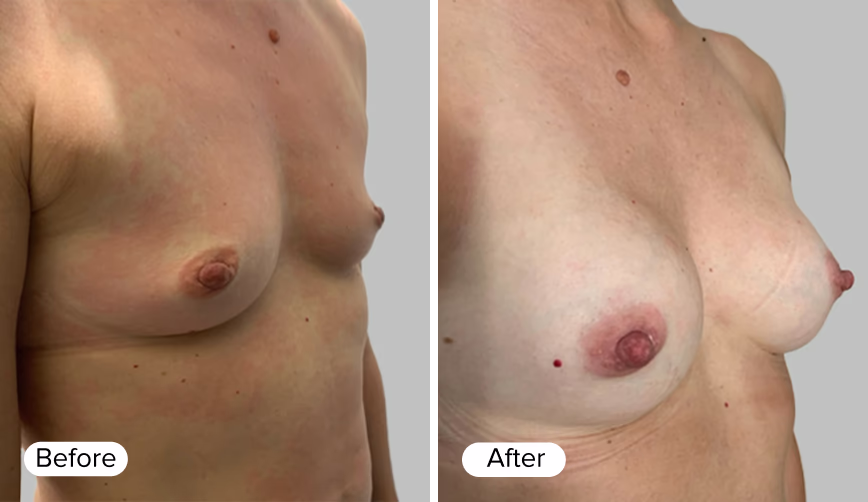 A side-by-side comparison of two images showing a person's chest area; the left side has a label 'Before' and the right side has a label 'After'.