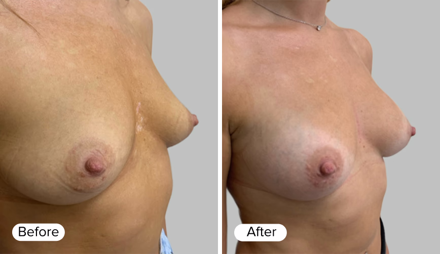 A side-by-side comparison of a woman's chest showing two images labeled 'Before' and 'After'. The 'Before' image displays natural breasts, while the 'After' image shows enhanced breasts.