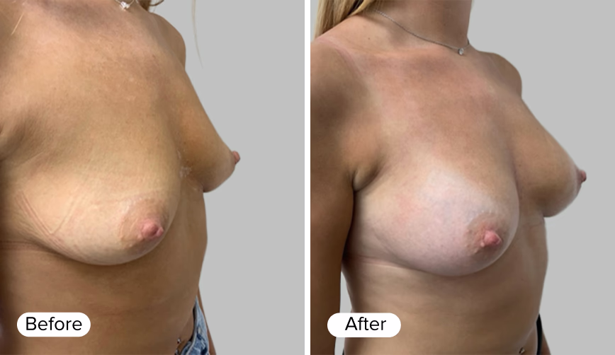 A side-by-side comparison image featuring two female torso images, labeled 'Before' on the left and 'After' on the right, showing the differences in appearance.