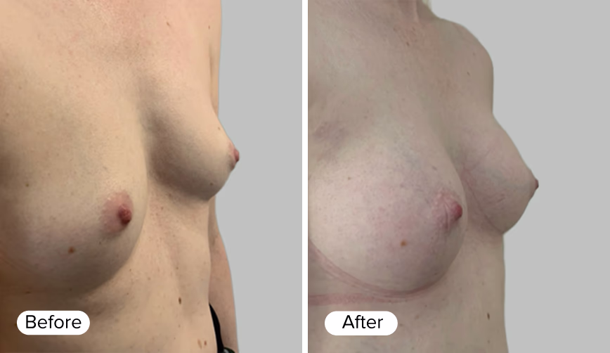A side-by-side comparison image labeled 'Before' on the left and 'After' on the right, depicting changes in breast appearance.