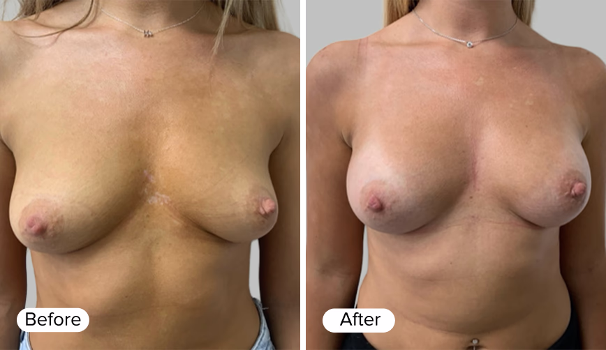 Before and After images showing a woman's torso, with the word 'Before' in light text on the left and 'After' in light text on the right.