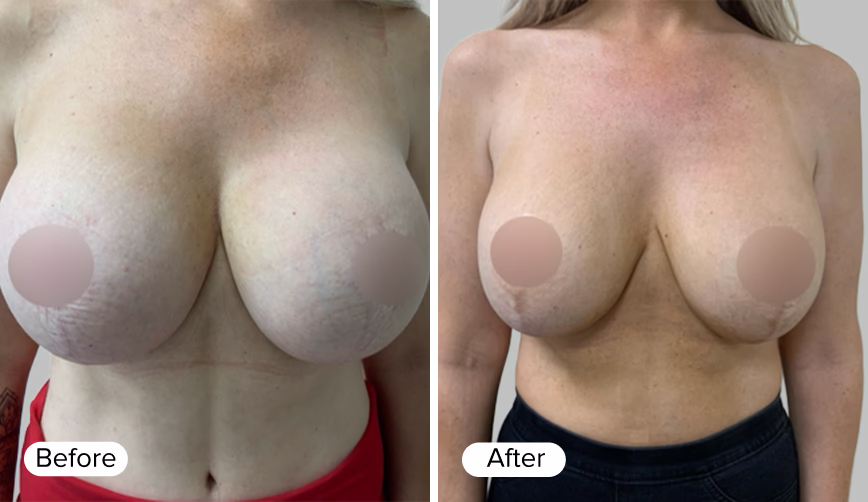 A side-by-side comparison of two images depicting the same female figure. The left image is labeled 'Before' and shows a less defined breast shape, while the right image is labeled 'After' and shows a fuller, more contoured breast shape. Both images