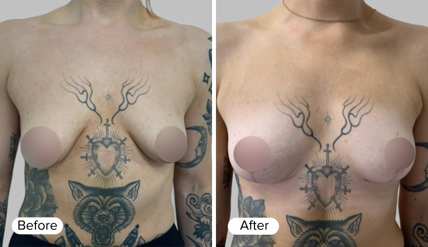 A side-by-side comparison of a woman's chest, with visible tattoos including a heart and antlers, showing 'Before' and 'After' labels at the bottom left and right corners.