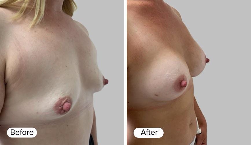The image shows two side-by-side photographs of a woman's upper torso before and after a procedure. The left photo is labeled 'Before' and depicts a breast with less fullness, whereas the right photo is labeled 'After' and displays a breast with increased