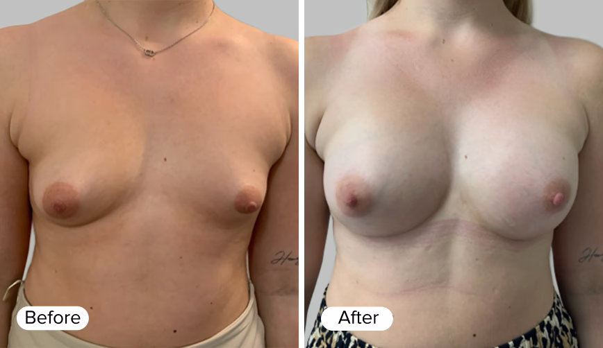 A side-by-side comparison image showing two female figures. The left side is labeled 'Before' and displays a natural appearance, while the right side is labeled 'After' and presents a modified aesthetic.