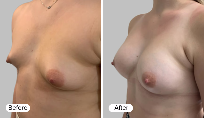 A side-by-side comparison image showing two female torsos labeled 'Before' on the left and 'After' on the right, illustrating changes in breast appearance after a procedure.