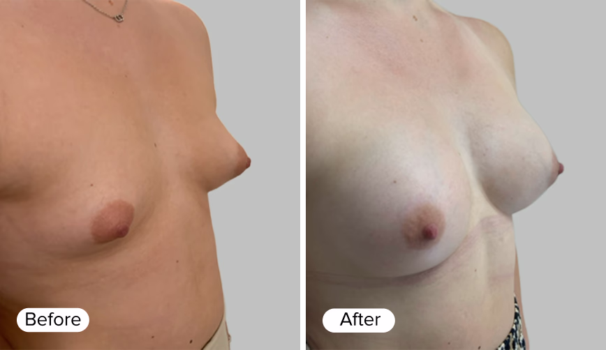 An image divided into two sections labeled 'Before' on the left and 'After' on the right. The left section shows a side view of a woman's chest before a procedure, while the right section displays the same view after the procedure, highlighting a fuller