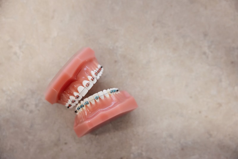 Clear aligners and braces treatment options displayed with branded dental materials