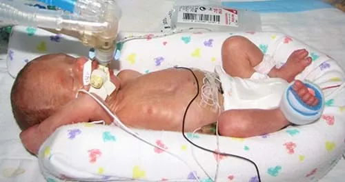 Low birth weight babies