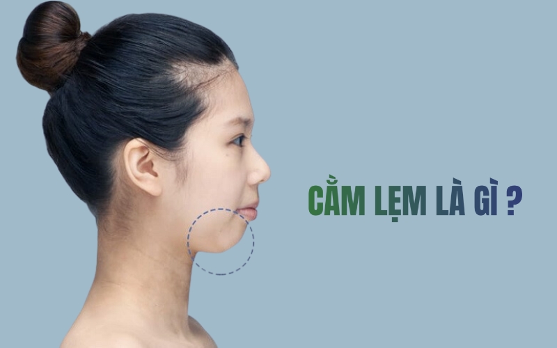 Cằm lẹm
