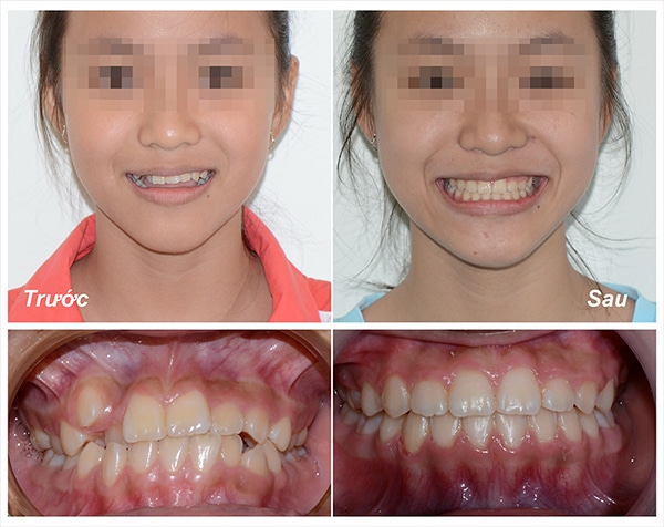 Thời gian tháo niềng răng