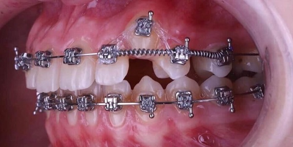 Lò xo niềng răng