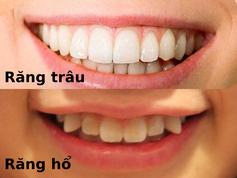 Răng trâu