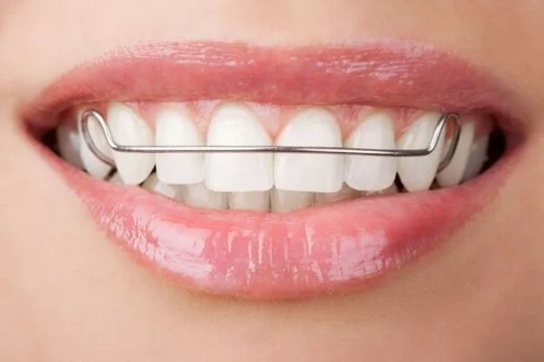 Cố định răng trước khi tháo niềng