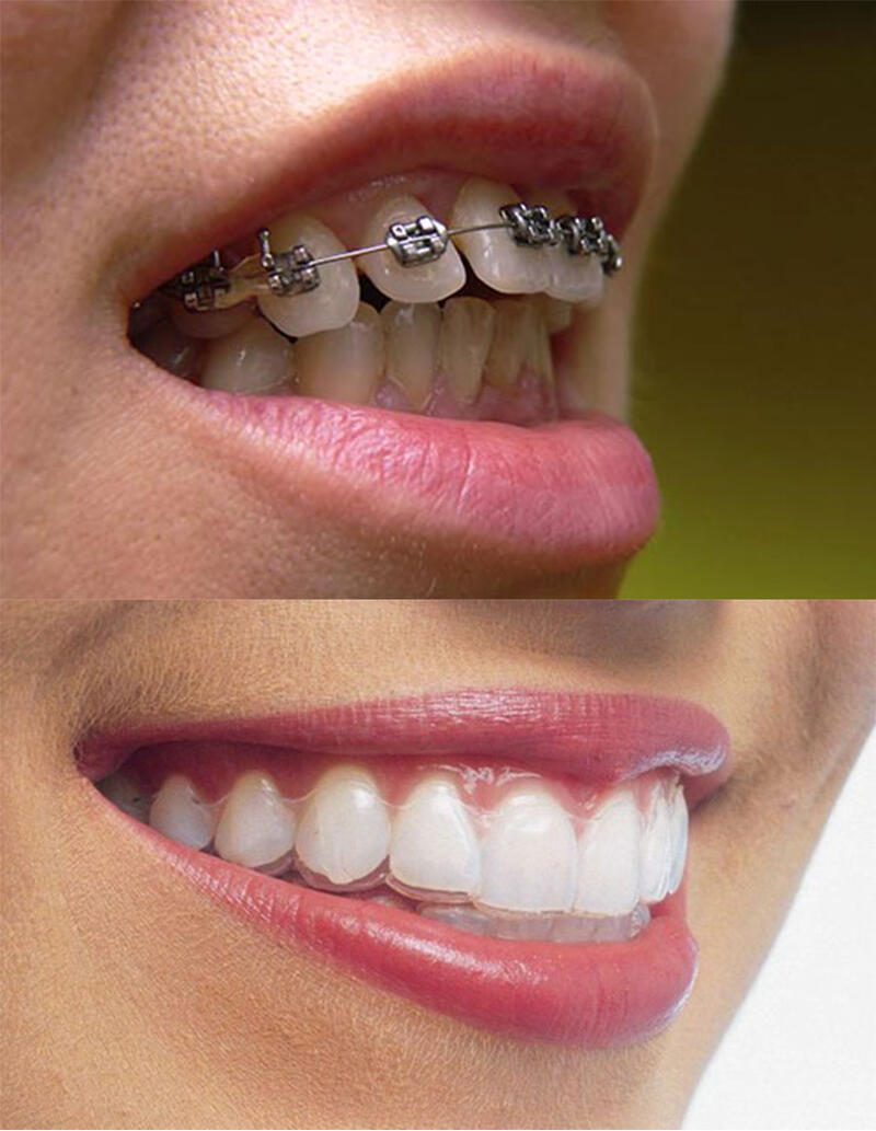 Niềng răng hô nhẹ