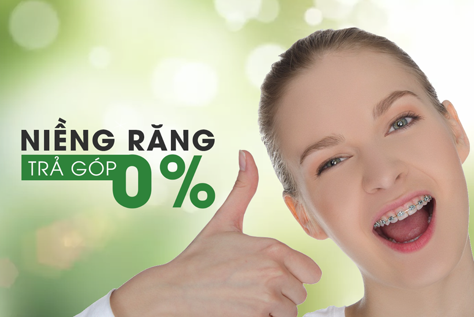 Niềng răng trả góp