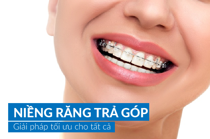 Niềng trả góp