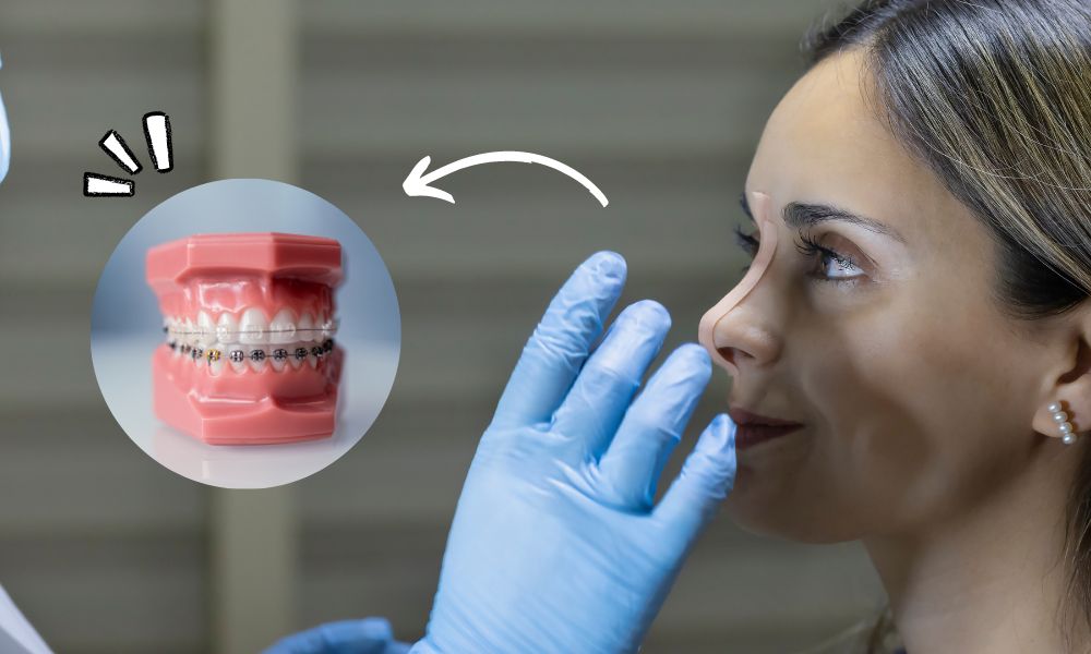 Niềng răng có làm mũi cao hơn không