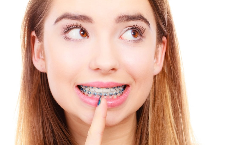 Niềng răng xăm môi