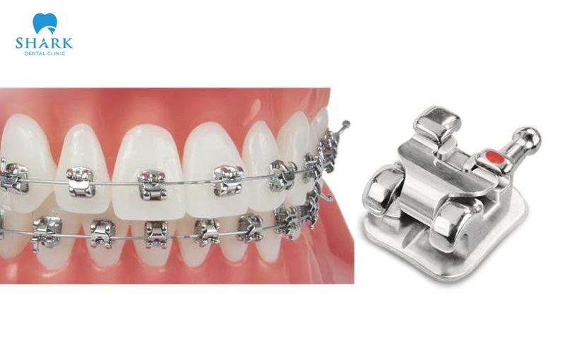 Niềng mắc cài 3M