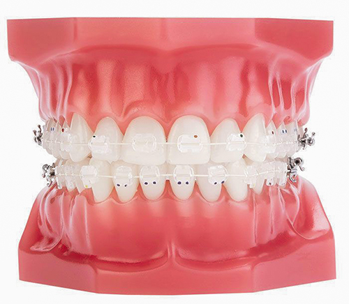 Niềng răng mắc cài 3M