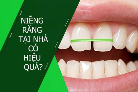 Tự niềng ở nhà