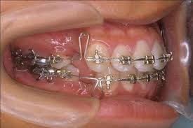 Loop đóng khoảng